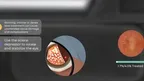 Retinopathy of Prematurity Simulator screenshot 3
