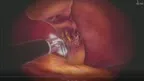 SurgicaVR screenshot 4