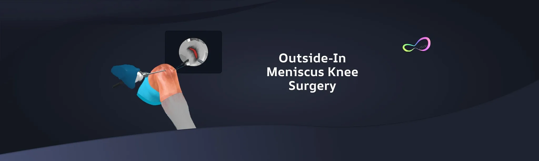 Meniscus Repair Outside In