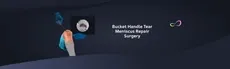 Bucket Handle Meniscus Tear Surgery hero image